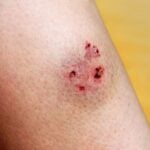 if bitten dog What do immediately and treatment method