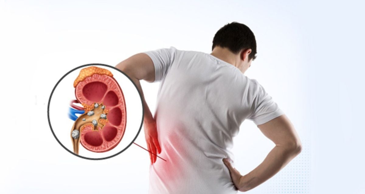 recurrent kidney stones symptoms And How to prevent Full Details