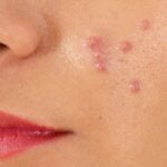 Super tips to remove and prevent face Pimples