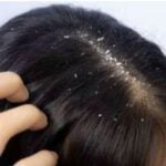 Yogurt and aloe vera Natural Home Remedy for Dandruff