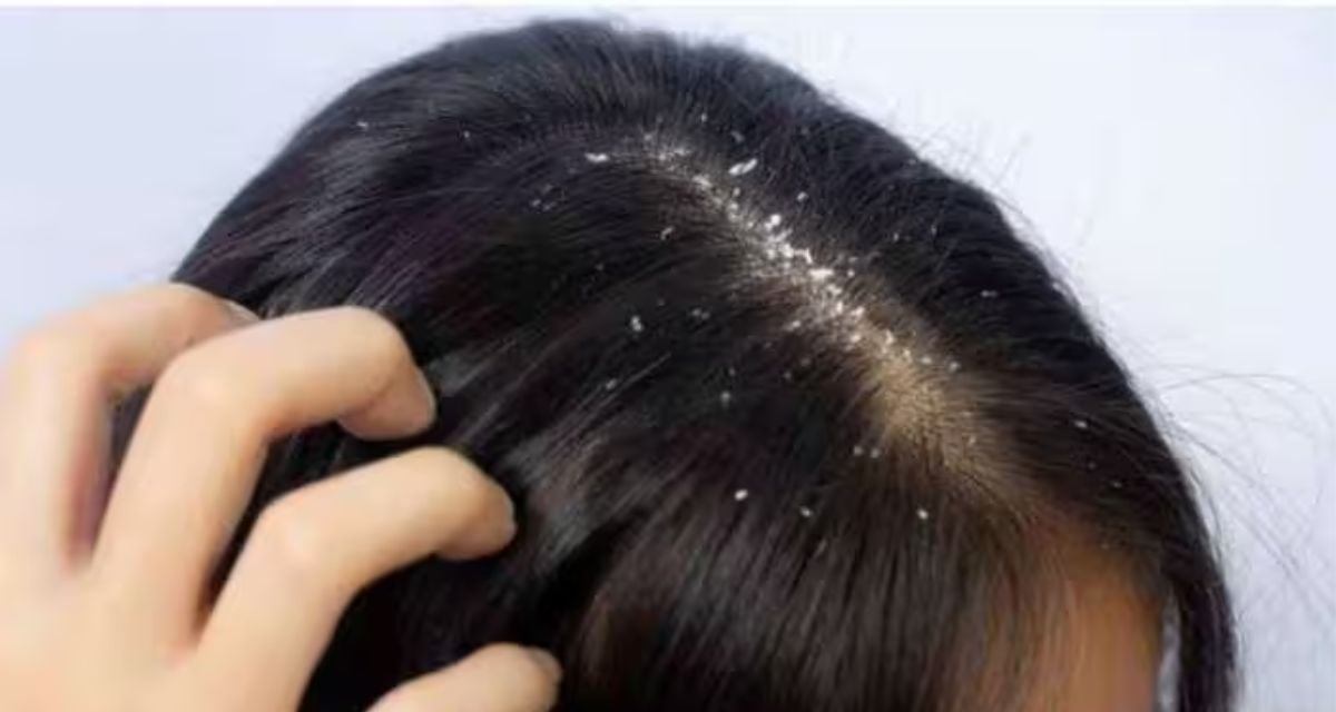 Yogurt and aloe vera Natural Home Remedy for Dandruff