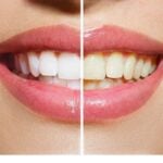 home remedies to whiten yellow teeth