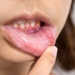heal mouth ulcers quickly Super home remedies