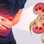 kidney stones what Foods to eat and avoid