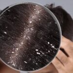 natural home remedies to get rid of dandruff and hair growth