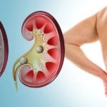 kidney stones Symptoms and how to prevent