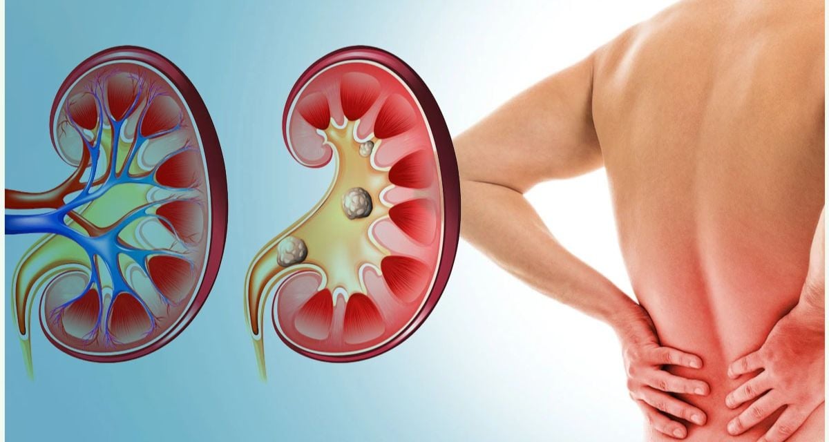 kidney stones Symptoms and how to prevent