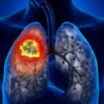 early symptoms of lung cancer Never ignore