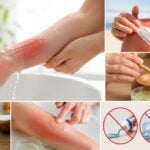 how to treat minor burn sunburn home remedies first aid