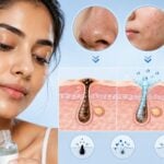 how to use salicylic acid for blackheads and acne targeted treatment