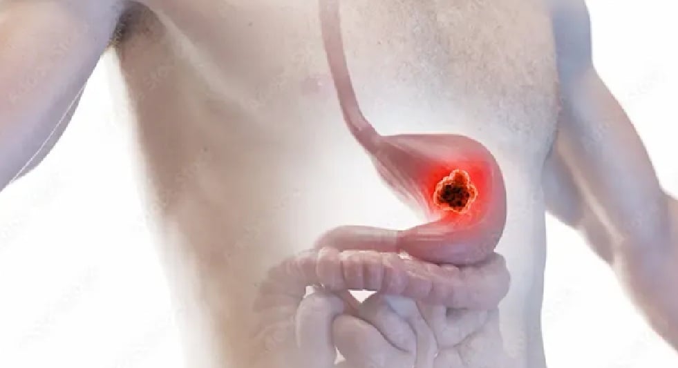 அல்சர் இருந்தால் என்ன செய்யலாம்?  7 வீட்டு வைத்தியங்கள்! natural home remedies for stomach ulcer