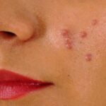 Understand that pimples are not the problem
