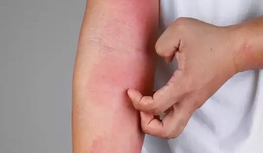 Treatment for sudden body swelling