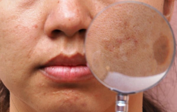How to Reduce and Prevent from Pigmentation?