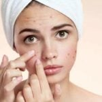 Easy Ways to Avoid Acne