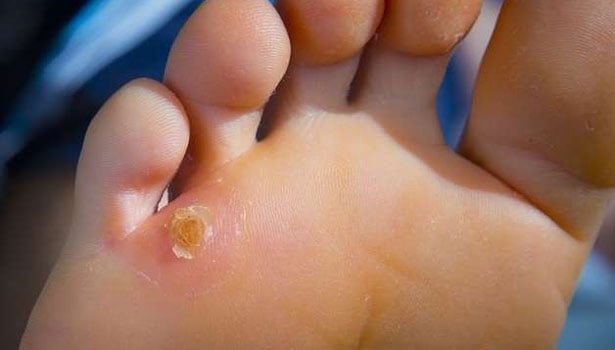 Toenail Fungus Diagnosis and treatment