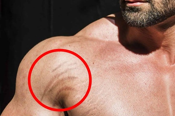 How to Remove scars from body?